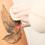 laser tattoo removal jobs