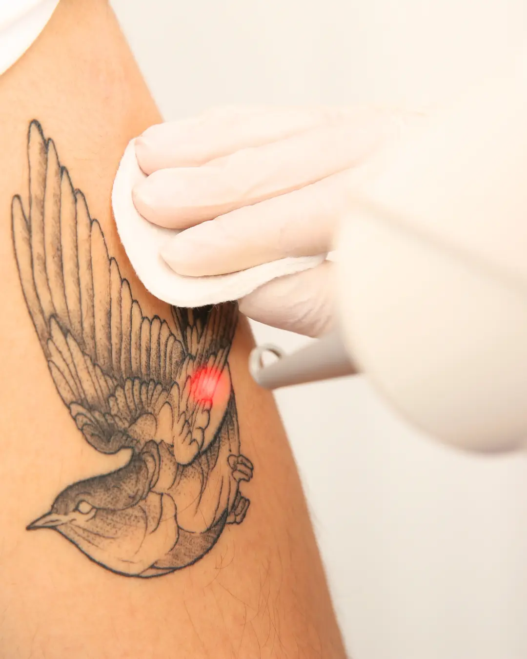 laser tattoo removal jobs